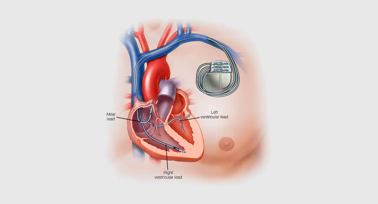 pacemaker implant