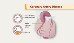 Coronary artery disease